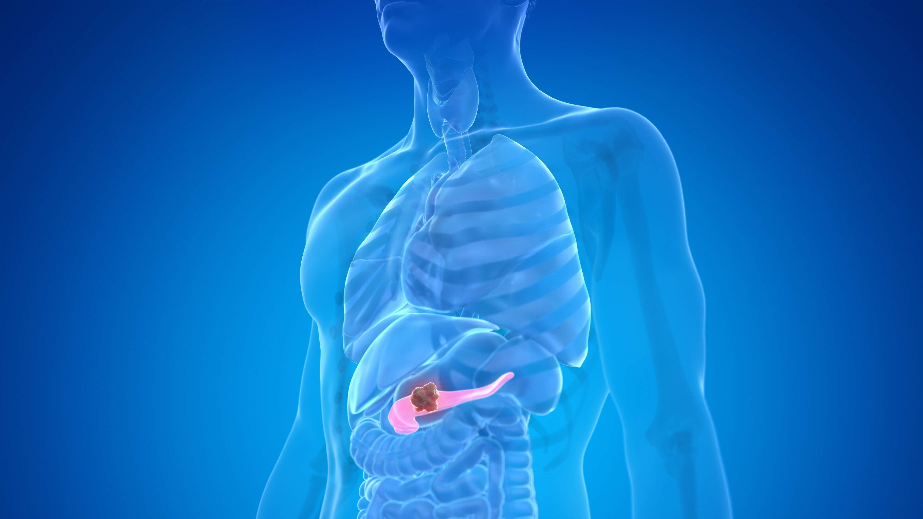 Advancements in Cancer Treatment Discussed at ASCO