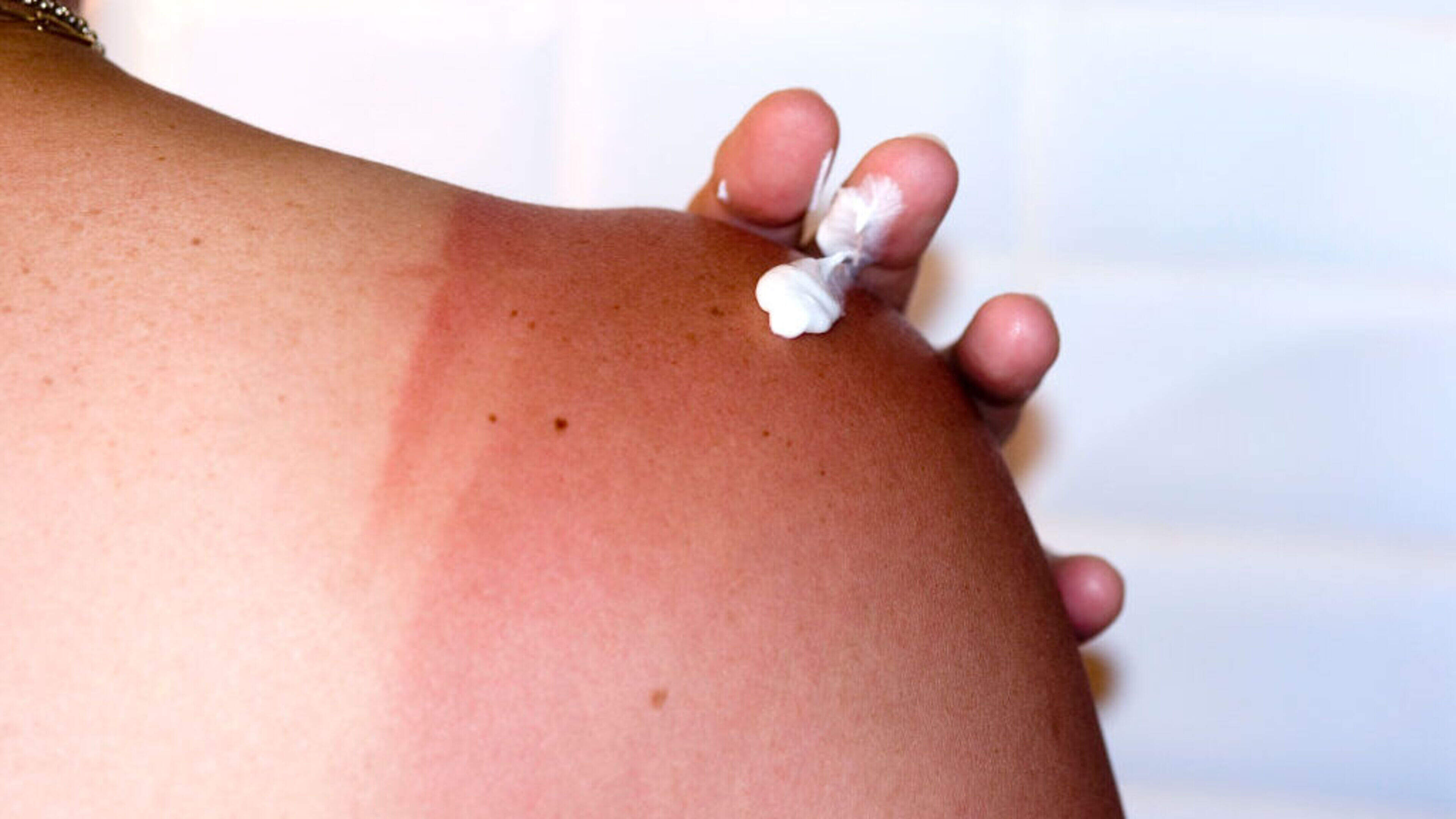Misinformation on TikTok Affects Sunscreen Use in Ireland