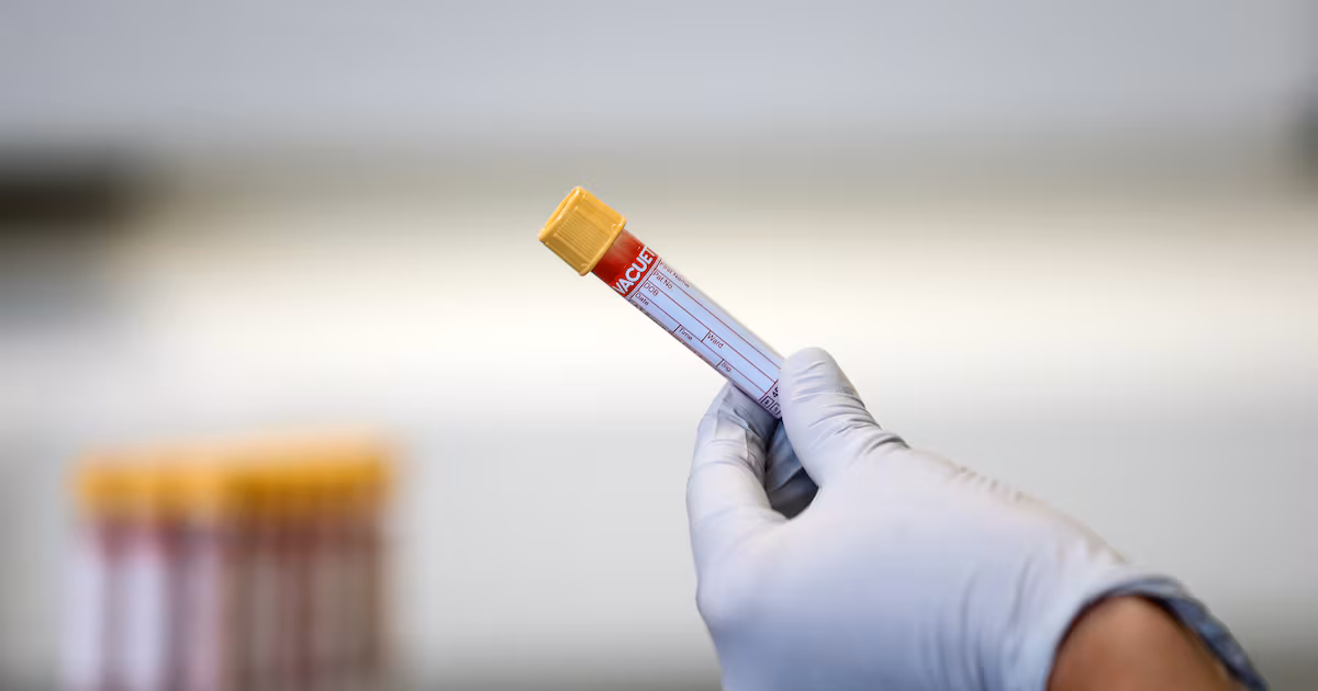 Blood test detects Sjogren's disease early