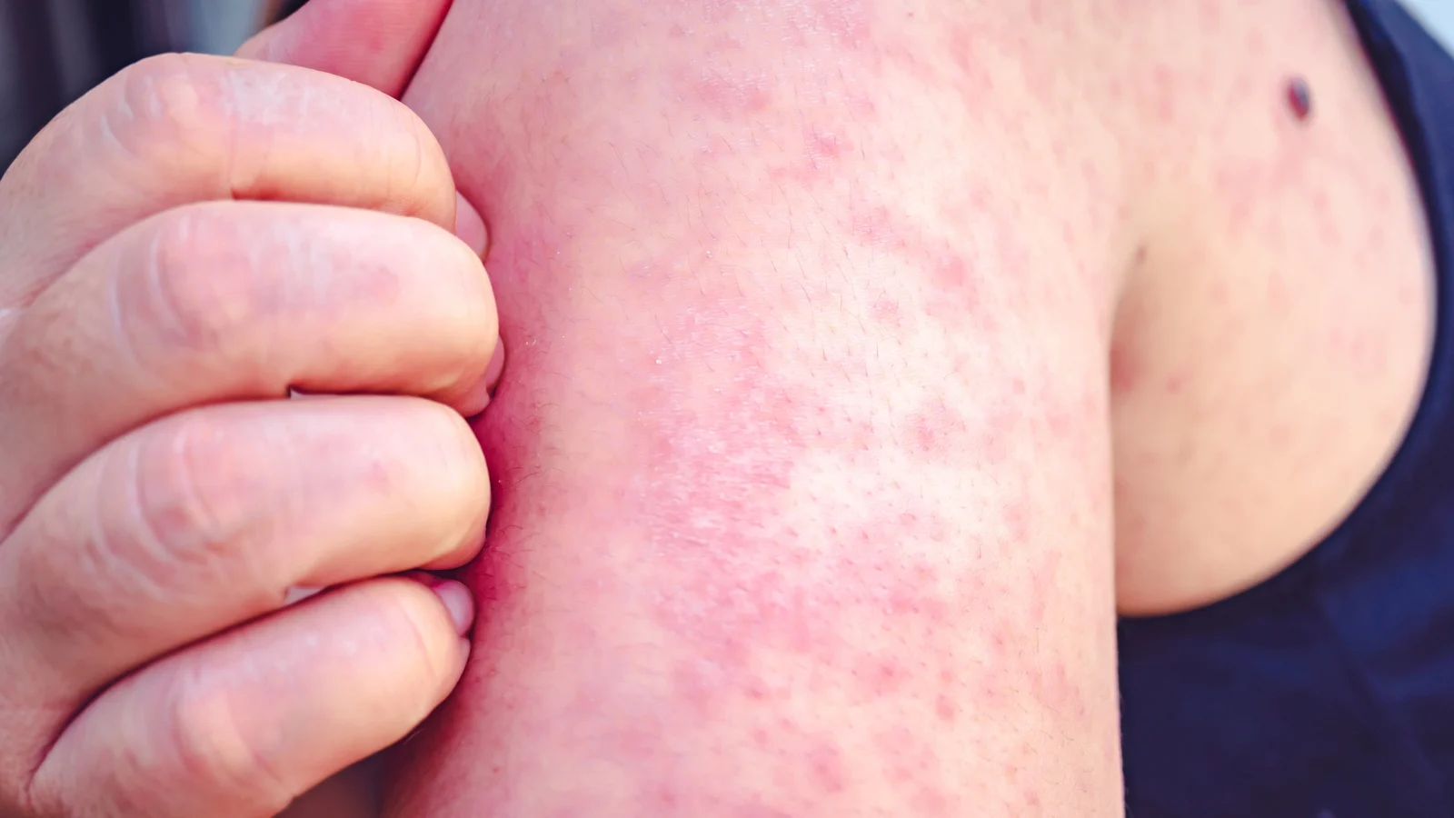 US faces worst measles outbreak in 35 years