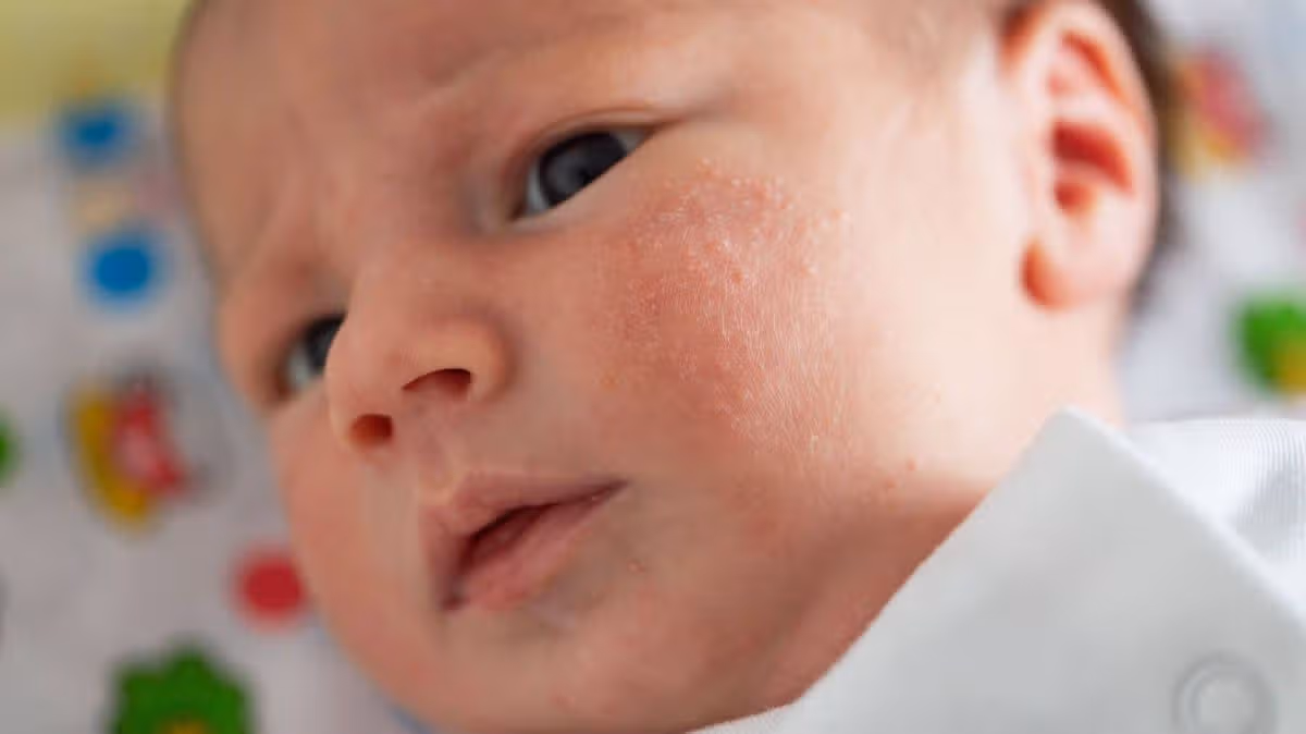 How to Spot Heat Rash in Children