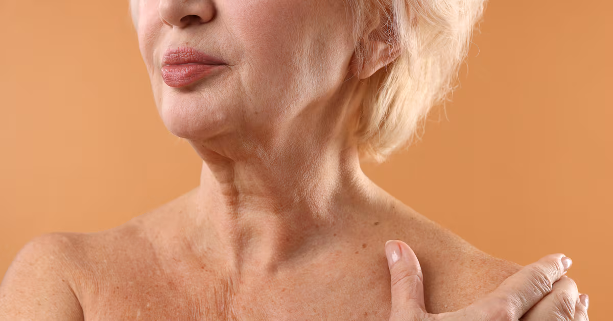 Understanding Sun Spots and Prevention Methods