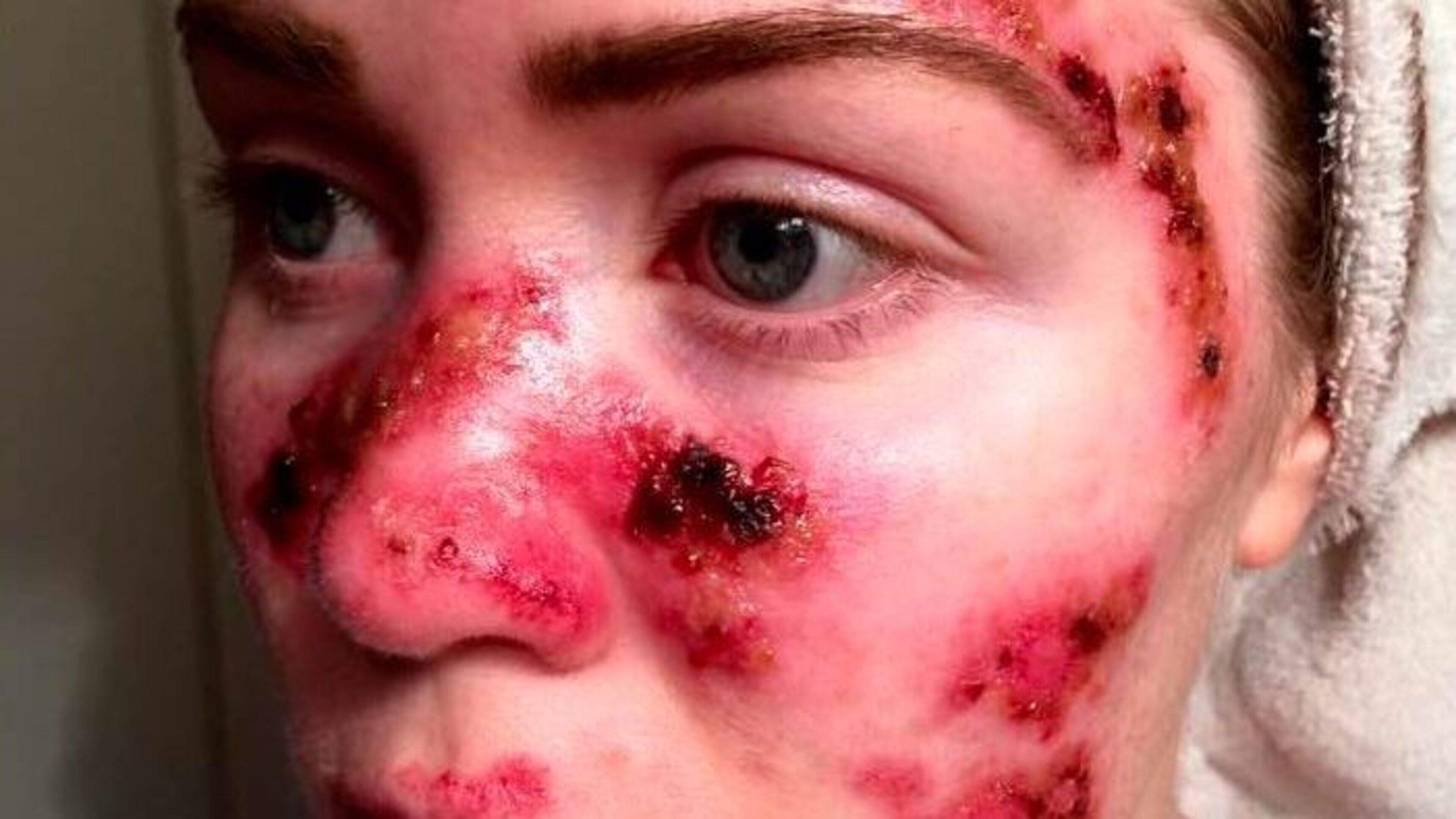 Fears of skin cancer surge after heatwave