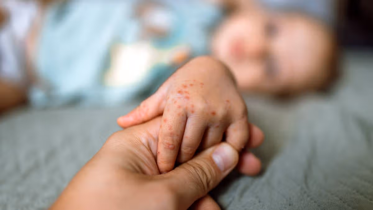 Nurse Shares Life-Saving Rash Monitoring Tip