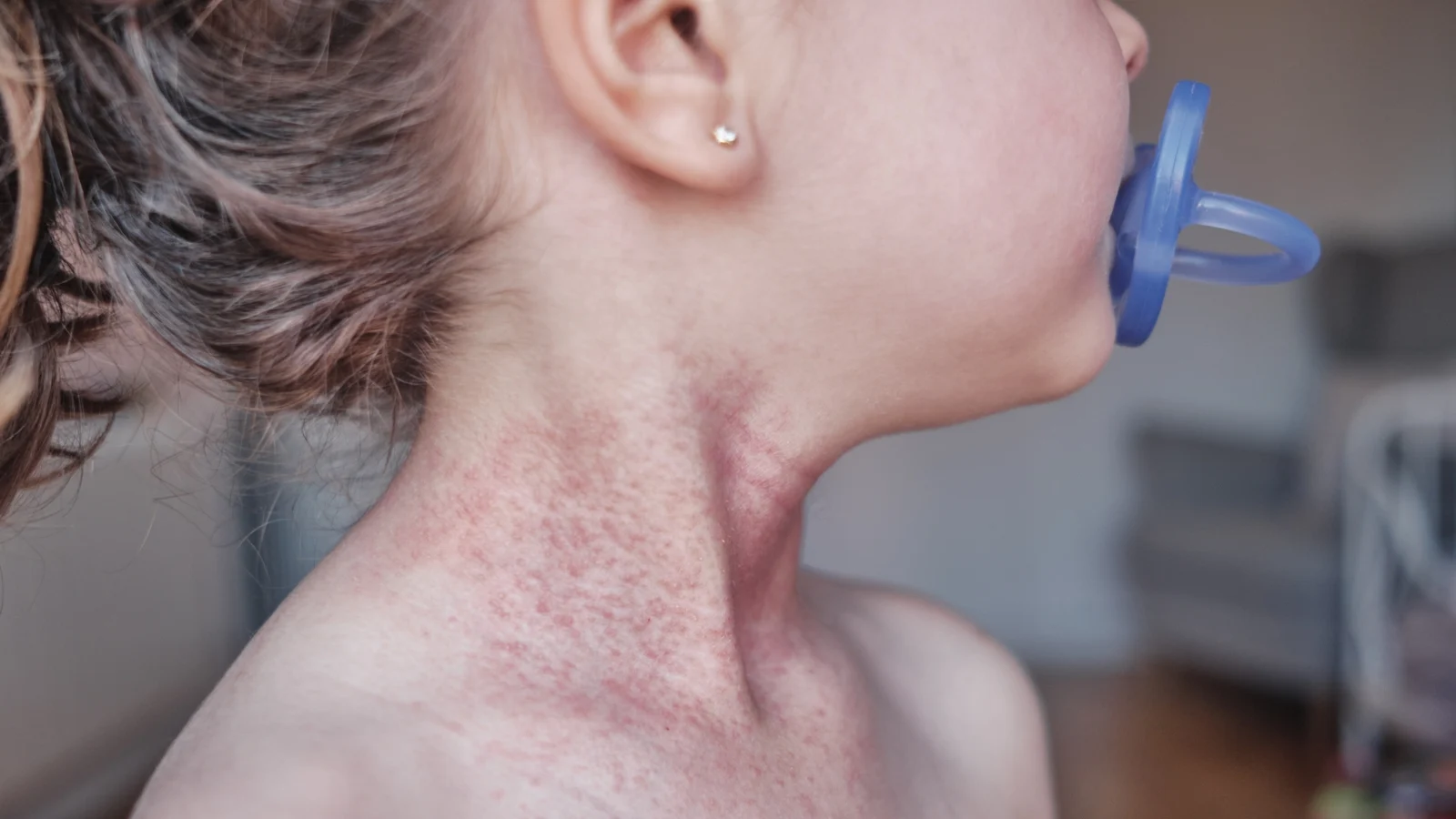 Severe eczema affects children's growth, study finds