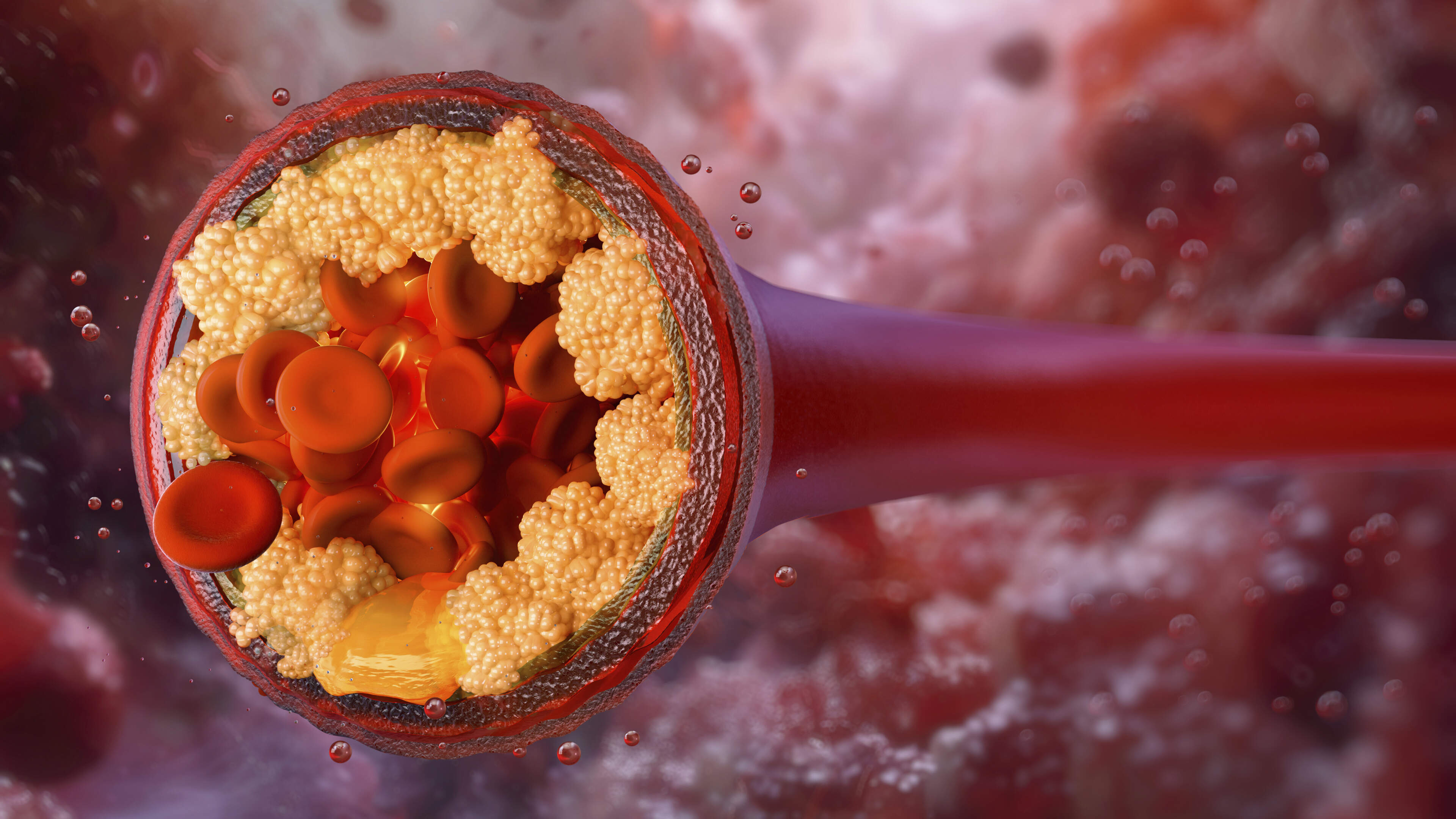 Single Jab Reduces Bad Cholesterol Levels